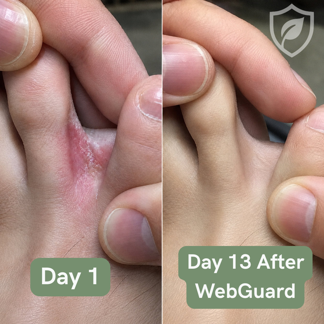 WebGuard Intertrigo Relief