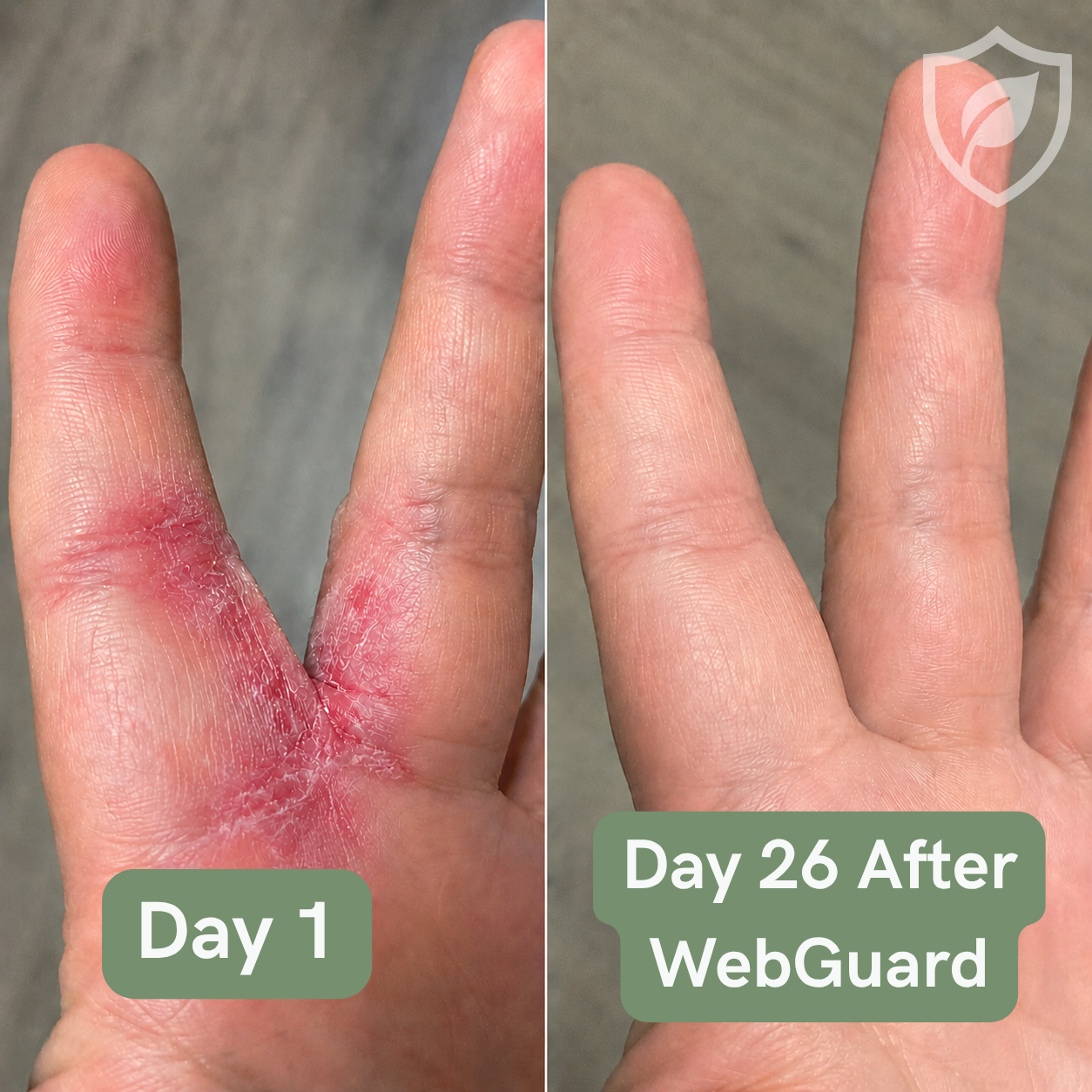 WebGuard Intertrigo Relief